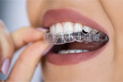 Aligners - Image 2