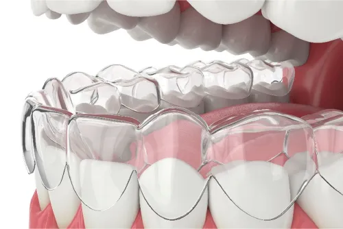 Aligners - Image 3